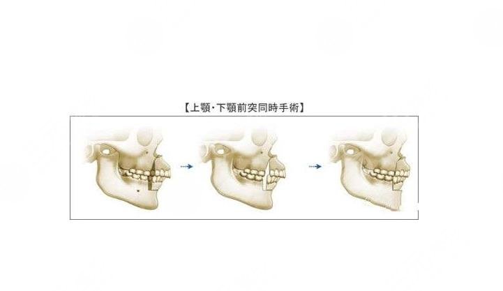 33歲地包天還能矯正嗎