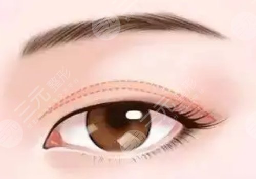 切雙眼皮怎么樣