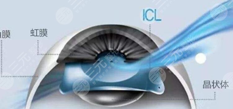 icl