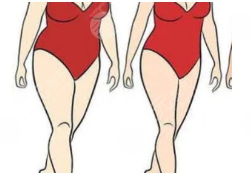 抽脂腰腹環(huán)吸多少錢