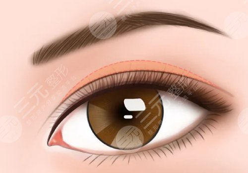 切雙眼皮修復(fù)手術(shù)多少錢(qián)