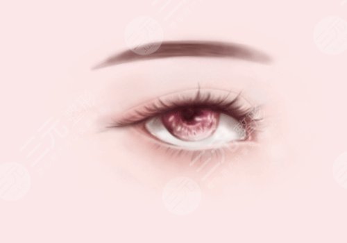 馬希達醫(yī)生雙眼皮案例