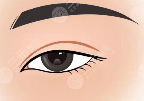 修復雙眼皮的價格