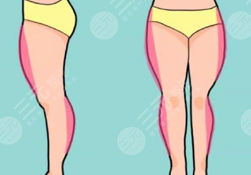 大腿抽脂的價格