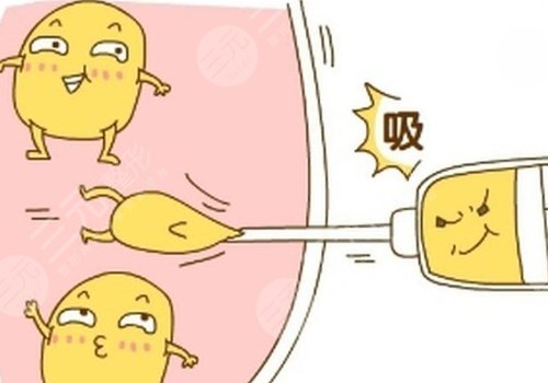 大腿抽脂的價格