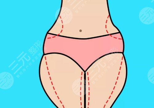 大腿抽脂的價格