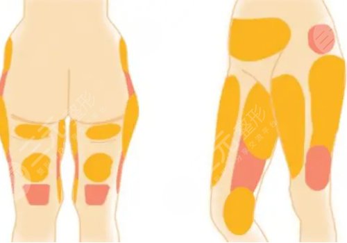 腿部吸脂需要多少錢