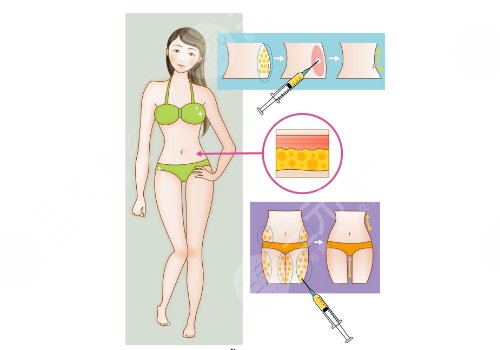 腿部吸脂需要多少錢