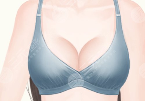 可以抽脂肪填充胸部嗎
