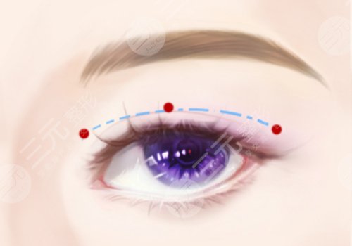 雙眼皮修復(fù)的價(jià)格