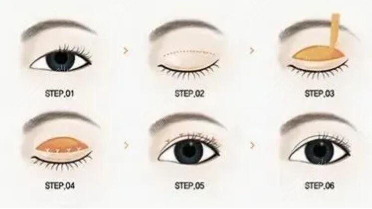 任沖醫(yī)生眼修復(fù)怎么樣?