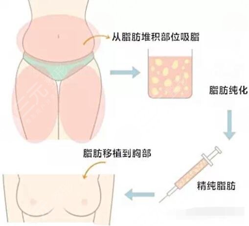 自體脂肪填充項目