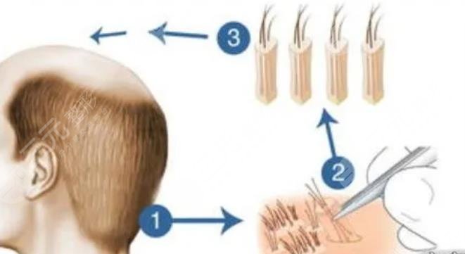 北京大學(xué)深圳醫(yī)院植發(fā)