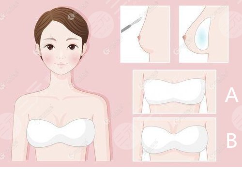 隆胸假體的價格