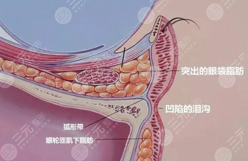 眼袋手術(shù)