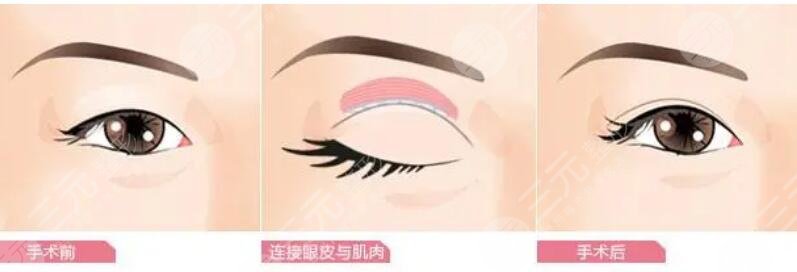 雙眼皮手術