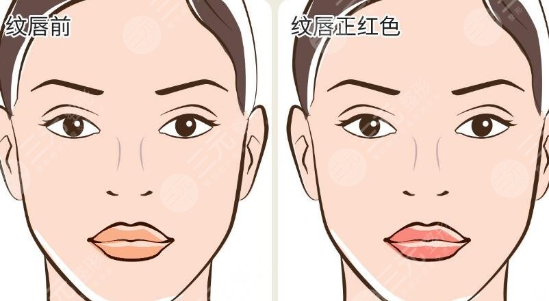 紋唇手術