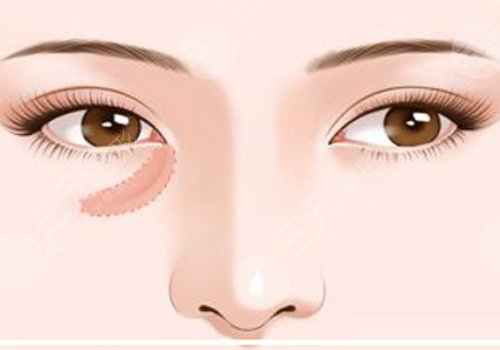 上海九院脂肪填充淚溝多少錢(qián)