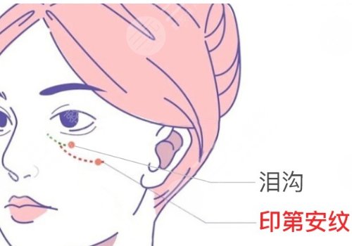 上海九院脂肪填充淚溝多少錢(qián)