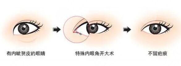 內(nèi)眼角