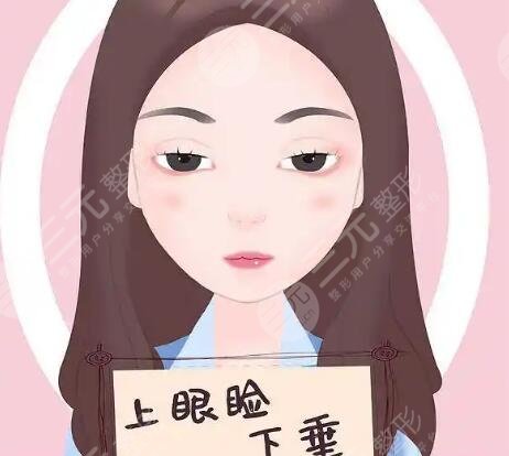 上瞼下垂