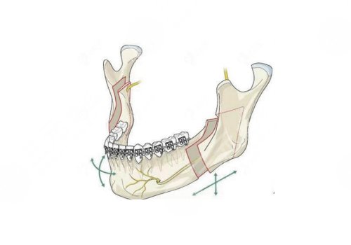 中山大學附屬口腔醫(yī)院做正頜手術怎么樣