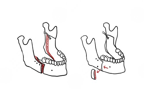 中山大學附屬口腔醫(yī)院做正頜手術怎么樣