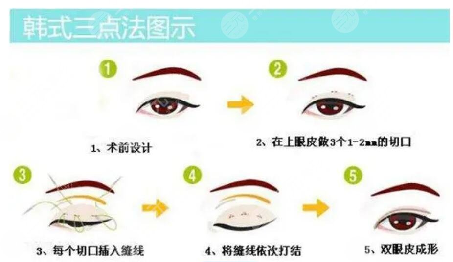 雙眼皮修復(fù)