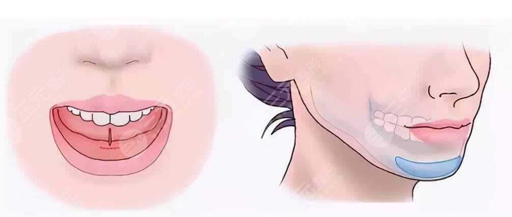 下巴后縮