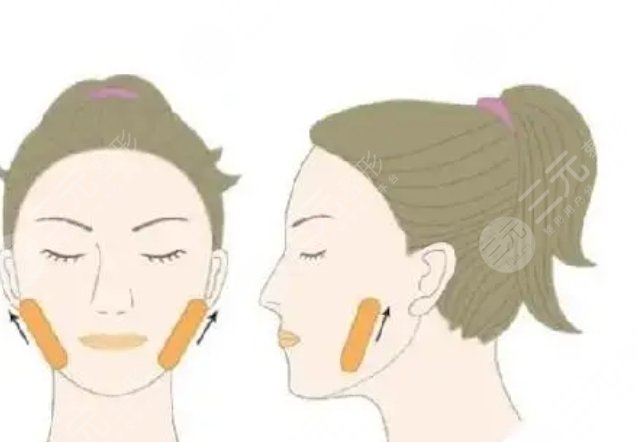 peek骨骼缺損修復(fù)重建