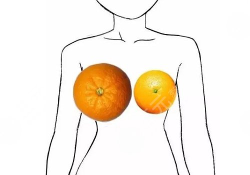 2025浙大二院易成剛縮胸手術多少錢