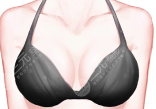 北京大學(xué)第三醫(yī)院隆胸價(jià)格