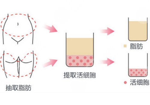 彭義坤和包濤哪個假體隆胸厲害？那個手感更真實？實力醫(yī)生PK