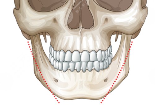 上海九院顴骨內(nèi)推和下頜角手術(shù)一起做多少錢