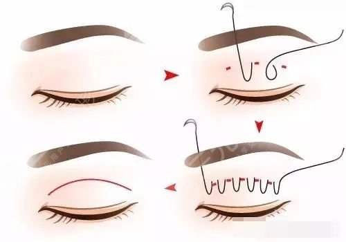 上海雙眼皮修復