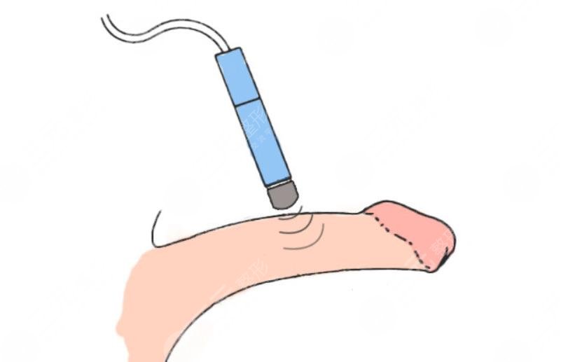 重慶生物補(bǔ)片手術(shù)