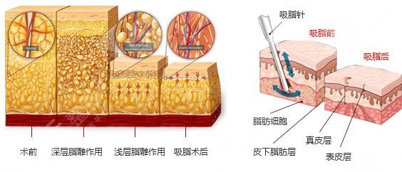 杭州面部吸脂多少錢