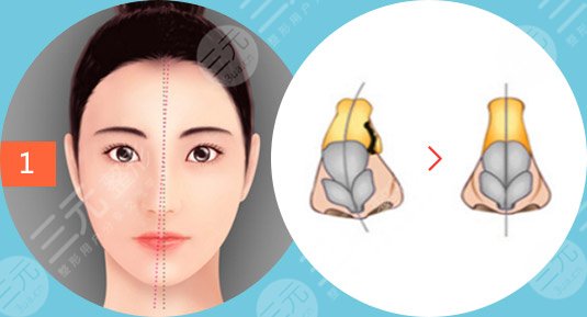 歪鼻矯正手術核心解析