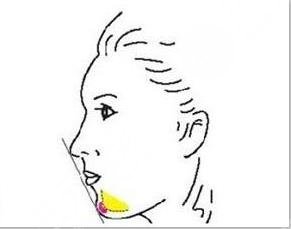 頦成型和假體隆下巴，到底哪種好?