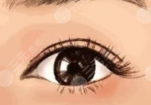 廣醫(yī)附一院雙眼皮價(jià)格是多少