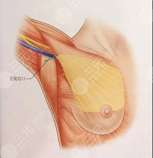 假體類型+脂肪填充量