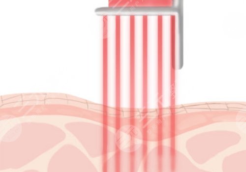 華康中醫(yī)醫(yī)院點陣激光