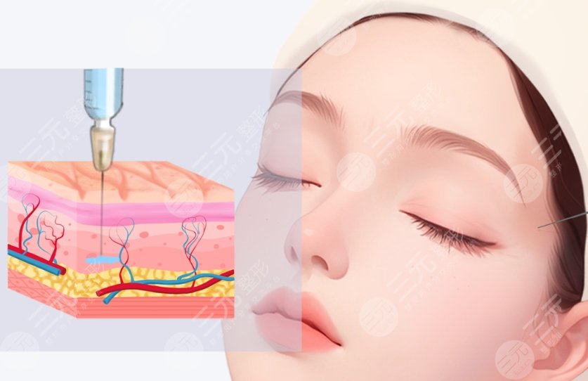 注射玻尿酸